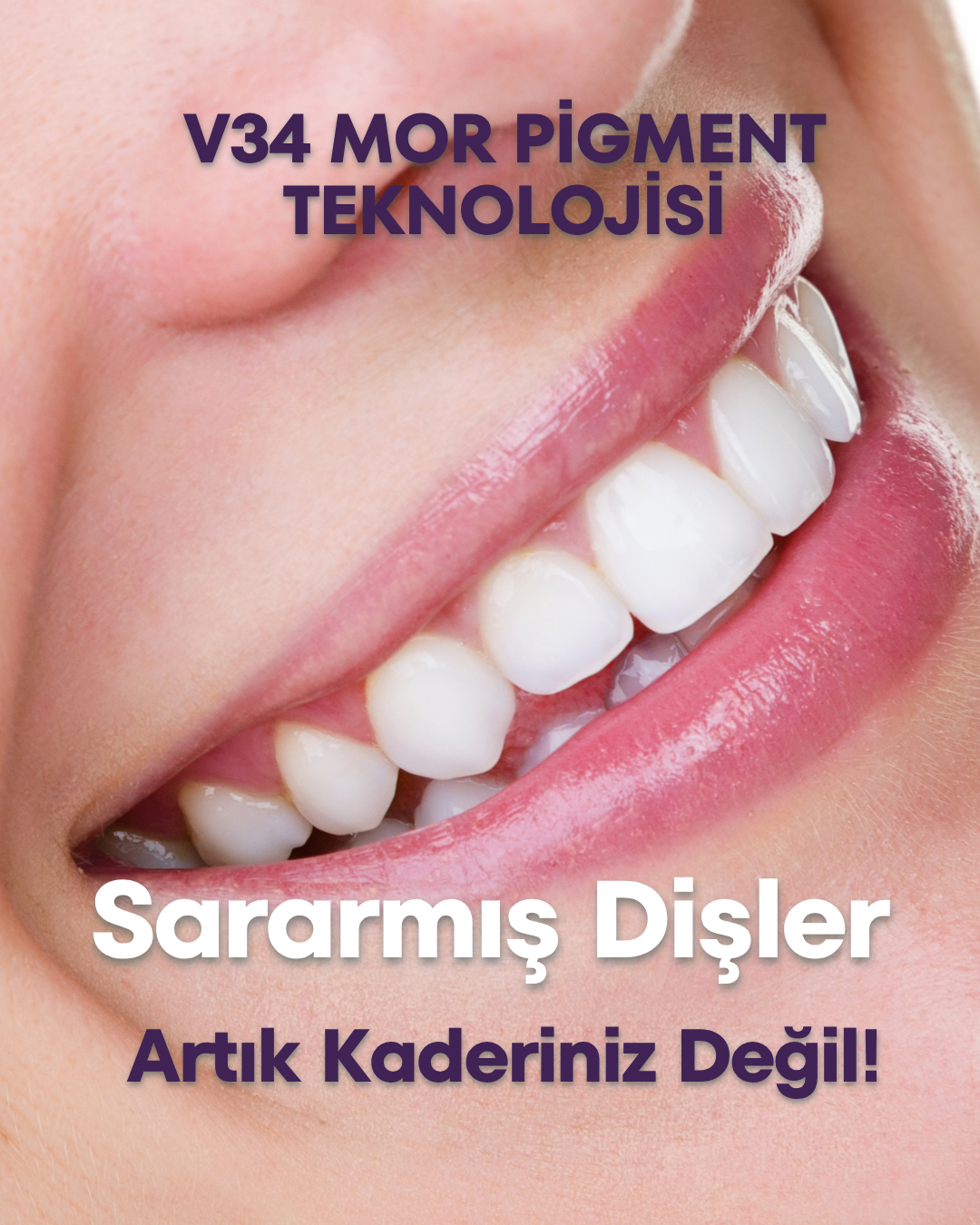 V34 Diş Beyazlatıcı Mor Pigment Jel