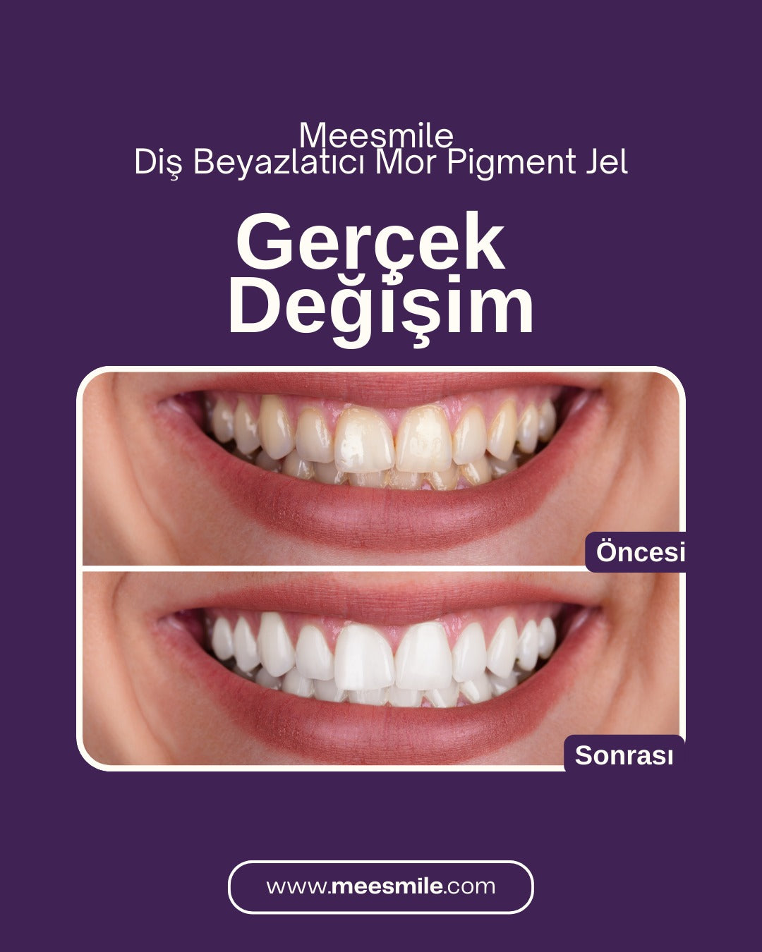 V34 Diş Beyazlatıcı Mor Pigment Jel